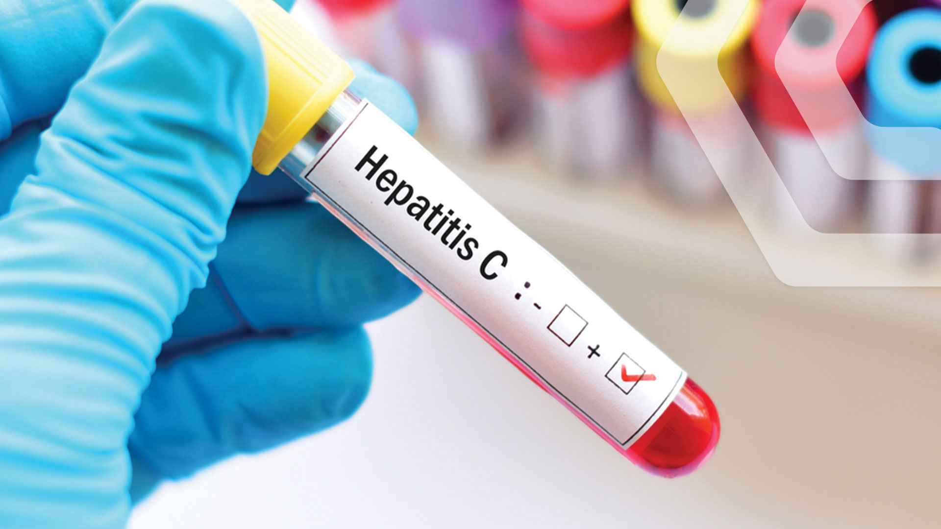 Hepatitis C