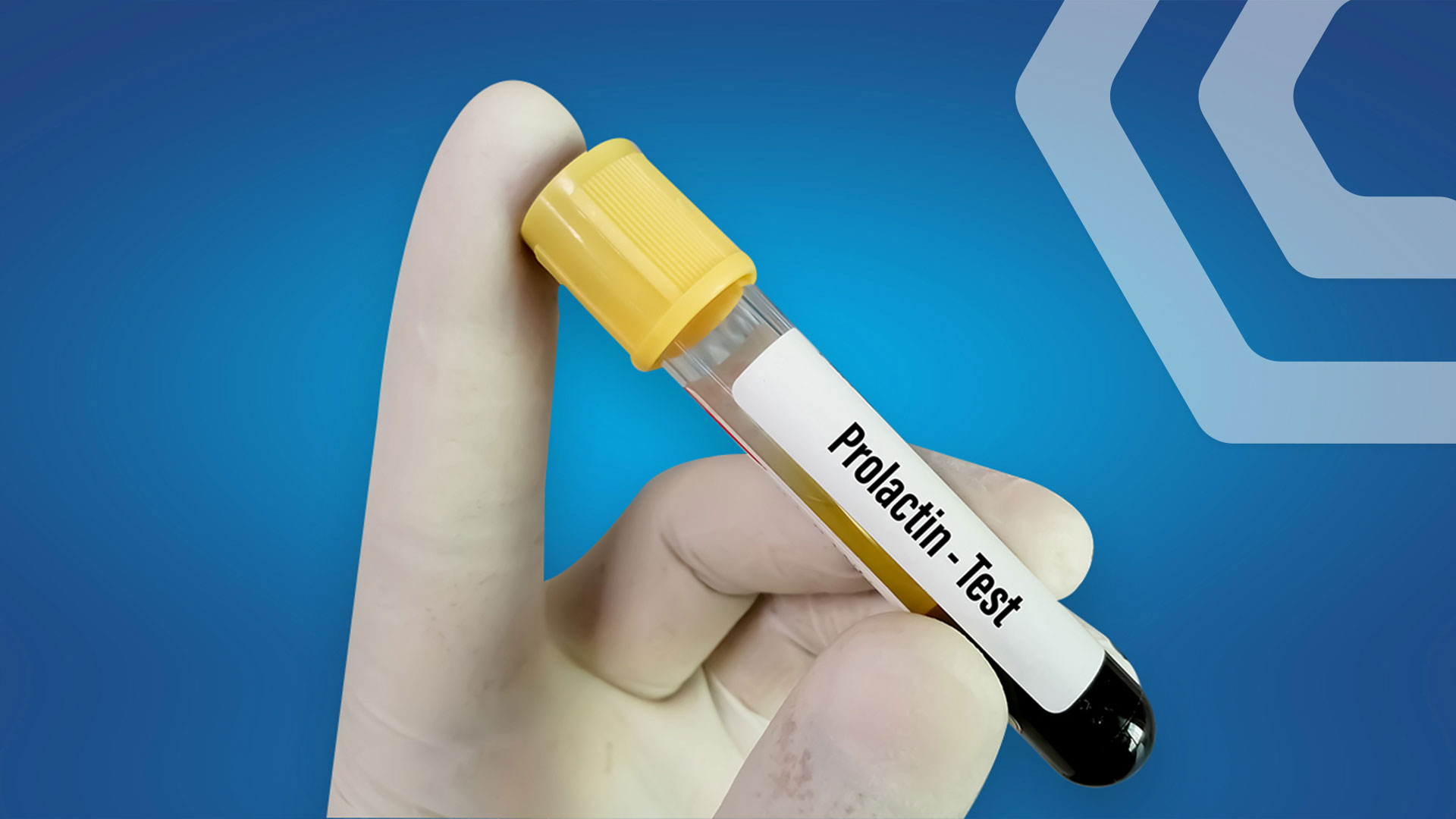 რა გავლენა აქვს პროლაქტინს ჩვენს ჯანმრთელობაზე?
