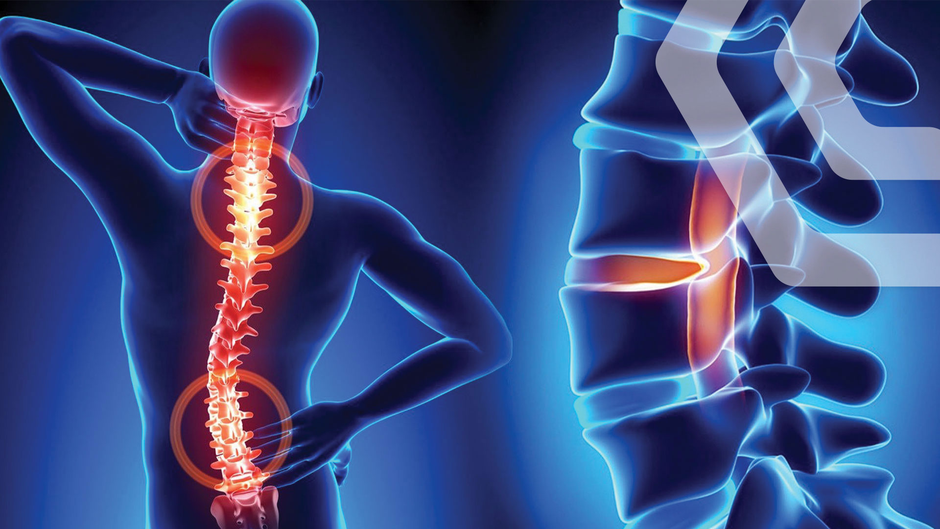 ოსტეოქონდროზი