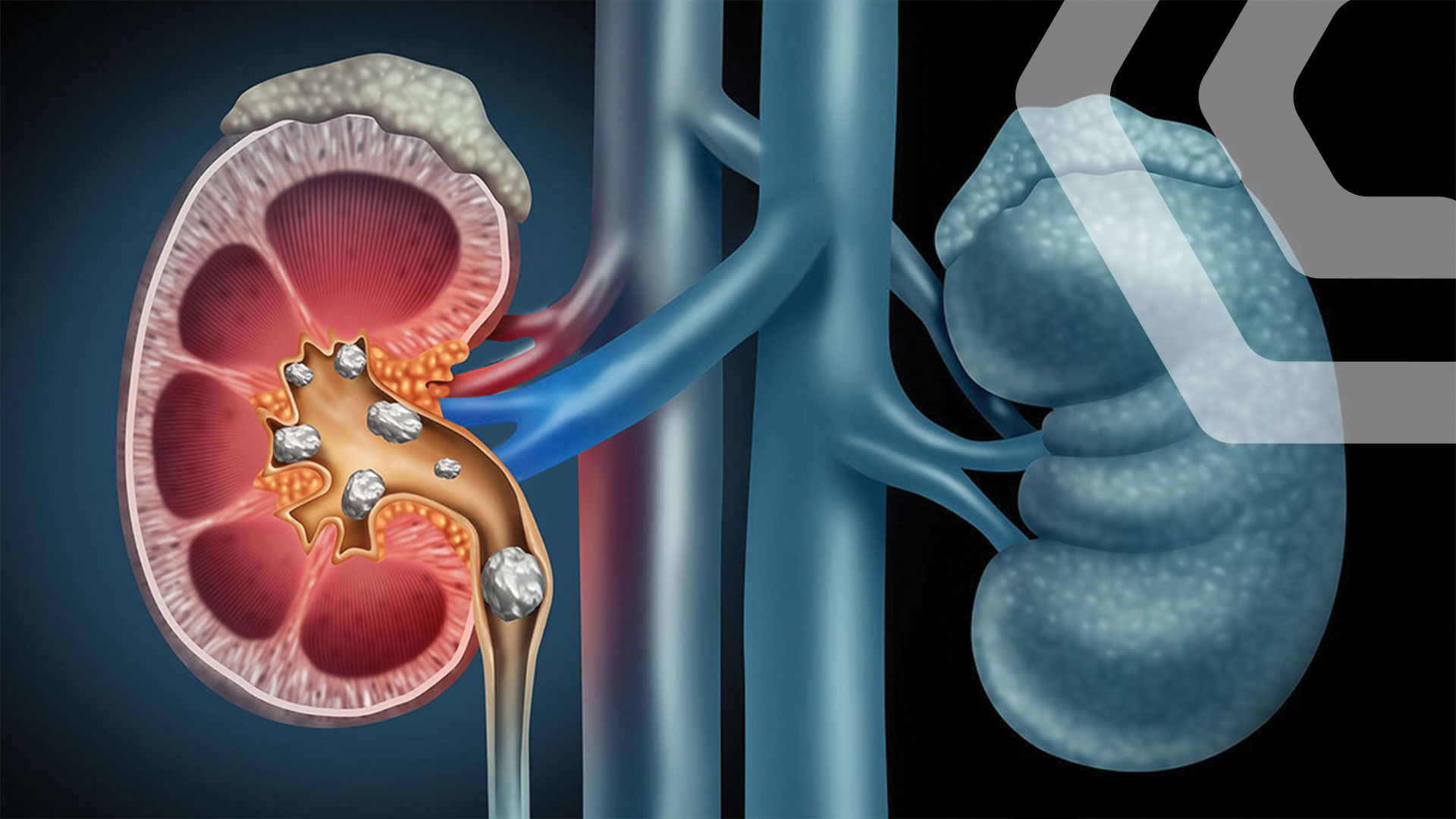 კენჭების დაგროვება