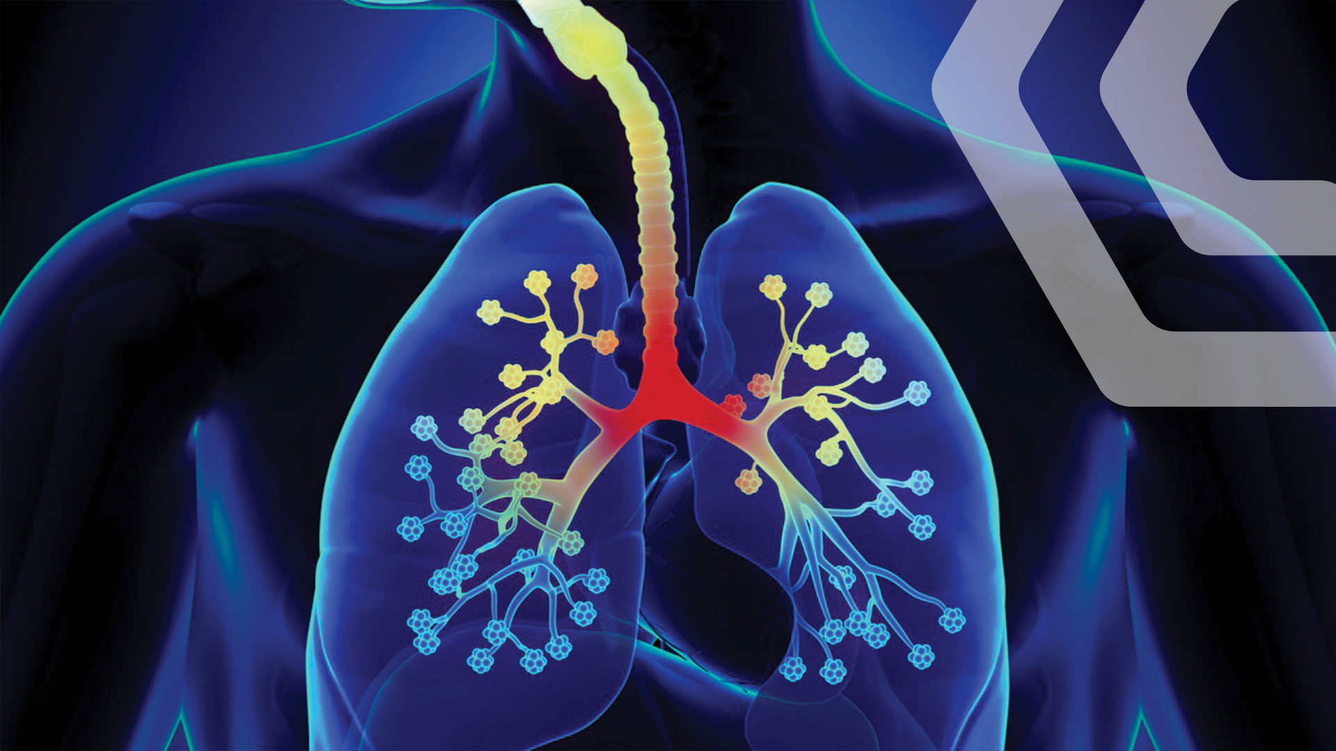 ბრონქიტი